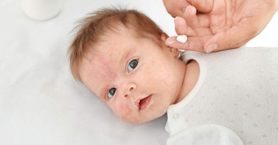 Baby heat rash in the summer?