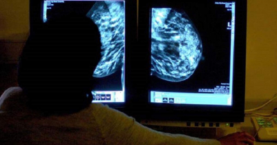 AI could halve time reading breast cancer scans!
