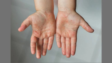 সিলেটে হামের উপসর্গে আরও দুই শিশুর মৃ`ত্যু, একজন মৌলভীবাজারের